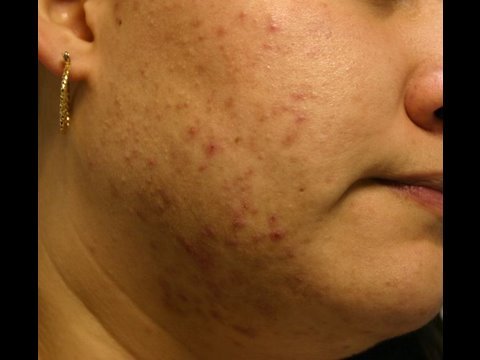 The Acne Practice  (redo in High Definition)