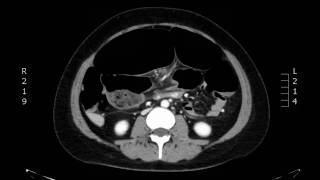 Volvulus, CT Axial. JETem 2017
