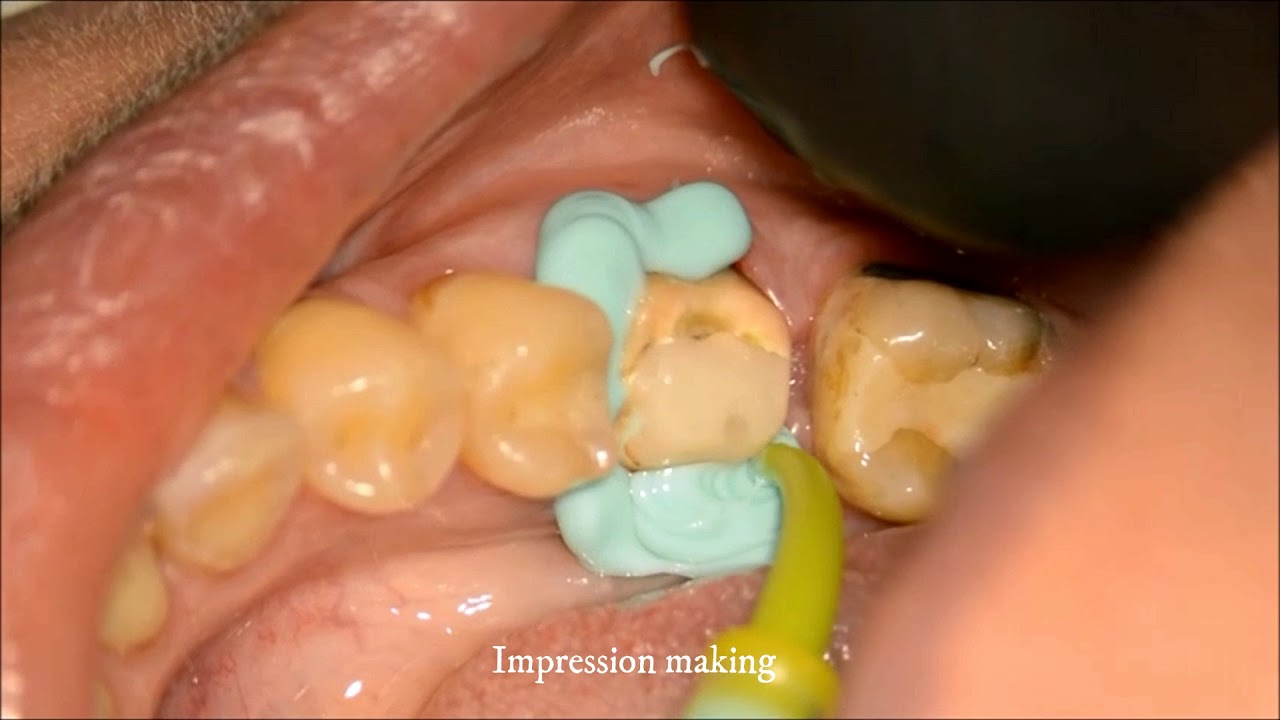 shoulderless crown preparation YouTube