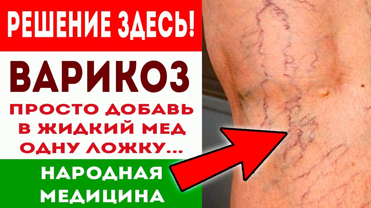 Чтобы избавиться от варикоза просто добавь в жидкий мед натертый ...
