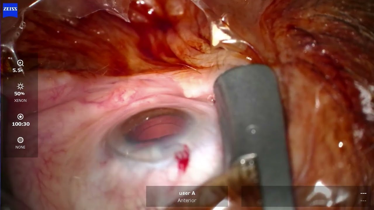 OS 2026 05 05 114439  Phaco Asphina + ELT