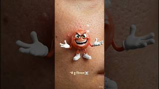 Pimple से छूटकारा 😰✅ – Ice, Neem & Aloevera Magic | #pimple #aishorts #education #viral #aloevera