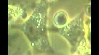 Видео Естественная смерть раковой клетки! (автор: Ольга Гоцева)