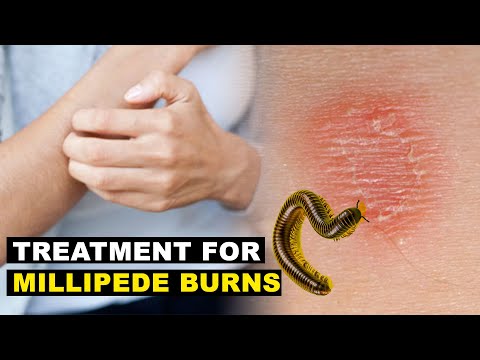 Best Treatment for Millipede Burns