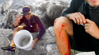 worst fishing accident fishing for shark bait