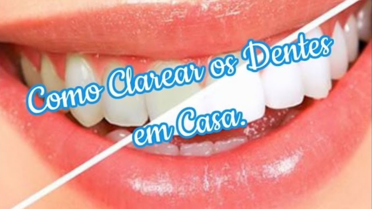 Clareamento Dental Caseiro Que Funciona Como Clarear Os Dentes Com Clareamento Caseiro Clareamento Dental Caseiro Que Funciona Como Clarear Os Dentes Com Clareamento Caseiro
