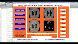 Types of Lung Cancer Detection Using CNN | Matlab Project With Source Code | Lung Cancer Analysis