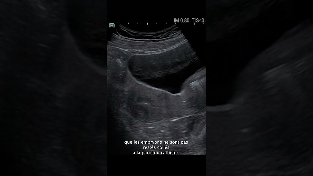 Perfect Embryo Transfer! 👶✨ IVF Success || 