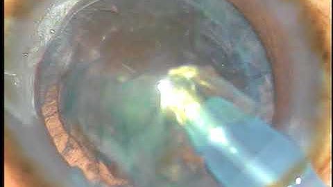 My    "LENS TILT TECHNIQUE" (LTT) for Soft Cataracts - P Mohanta, 8th April, 2018