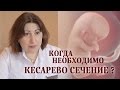 Когда кесарево сечение неизбежно?