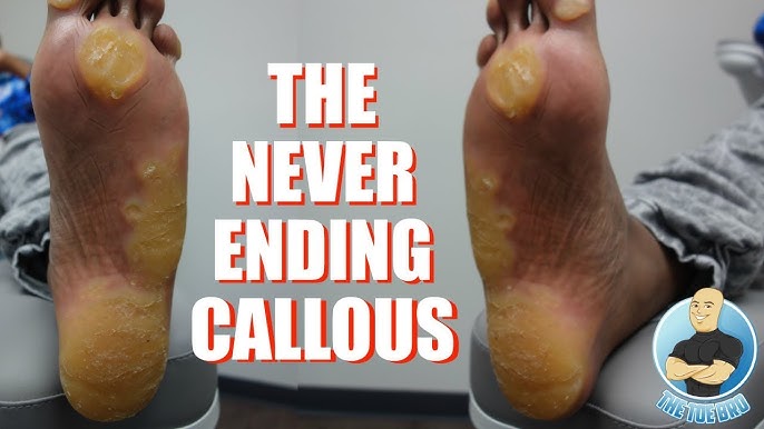 Foot Corn Removal — Bottom of Foot Callus Removal