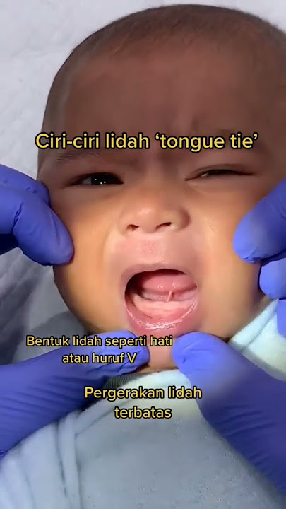 Bentuk Lidah Tongue Tie