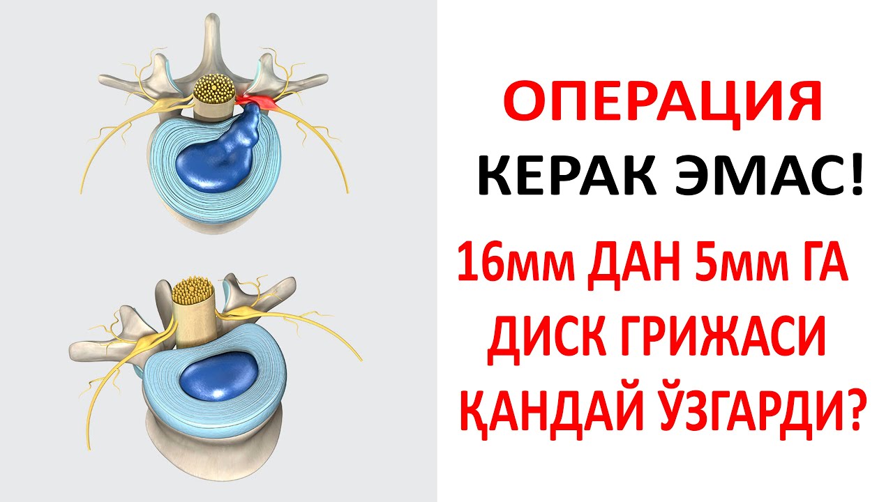 16мм ДАН 5мм ГА ДИСК ГРИЖАСИ ҚАНДАЙ ЎЗГАРДИ?  ВИДЕОНИ ОХИРИГАЧА КЎРИНГ САБАБИНИ БИЛИБ ОЛАСИЗ!