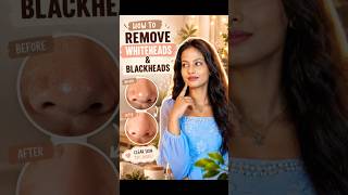 Day 7 ✨|Blackheads & whiteheads care #skintransformation #day7 #ytshorts #blackheads #whiteheads