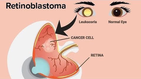 Hereditary Retinoblastoma as a result of RB1 Gene mutation; Causes, Symptoms and Treatment