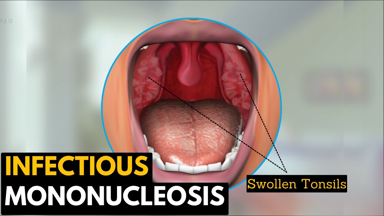 Infectious Mononucleosis, Causes, Signs And Symptoms, Diagnosis And Treatment.