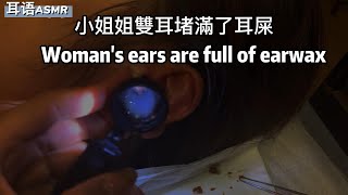 從耳朵裡面夾到的大塊耳垢 ▎Large pieces of earwax caught from inside the ear▎耳の中から引っかかった大きな耳垢 ▎귀에 큰 귀지가 끼임