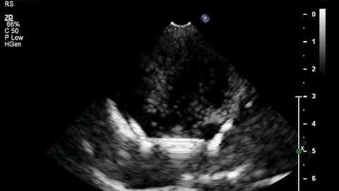 Microbubble Cavitation - Low Output Power