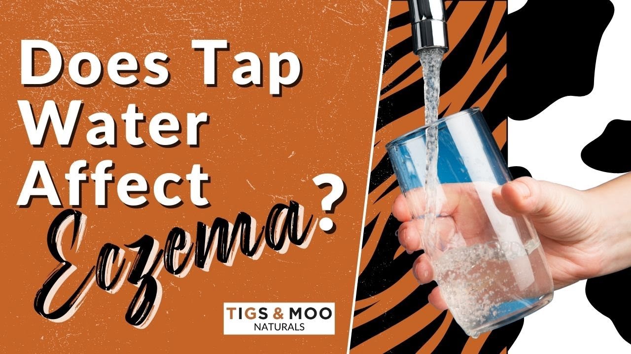 Does Tap Water Affect Eczema? YouTube