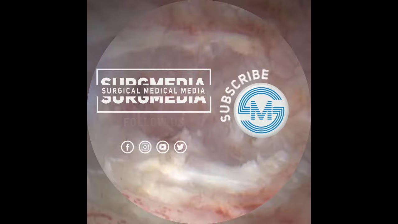 A Novel Technique (ATURBT) for Bladder Tumor