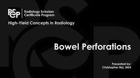 Bowel Perforations - Radiology Medical Education - RSCP Video Curriculum