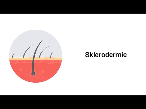 Video: Bessere Endoprothesenergebnisse, Hoffnung Auf Sklerodermie Und Mehr
