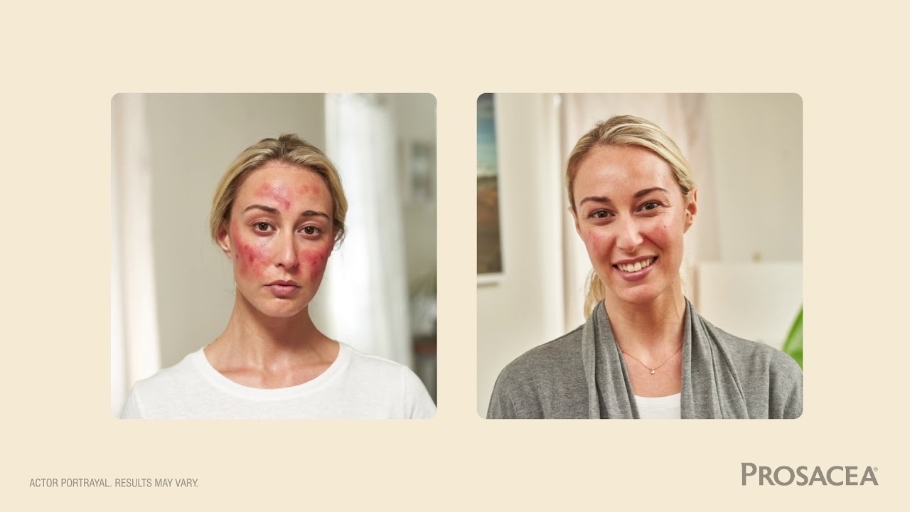 Prosacea Commercial 2021