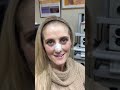 Post Rhinoplasty Septoplasty/Endoscopic Sinus Surgery 5days