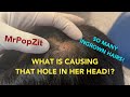 Interesting growth on the scalp pilar tumor must see how many hairs in tumor wait for mini pop