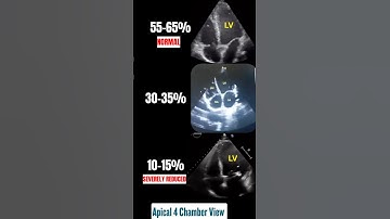 Normal to Severely Reduced Ejection Fraction on Echo | 4 Chambers view #echo
