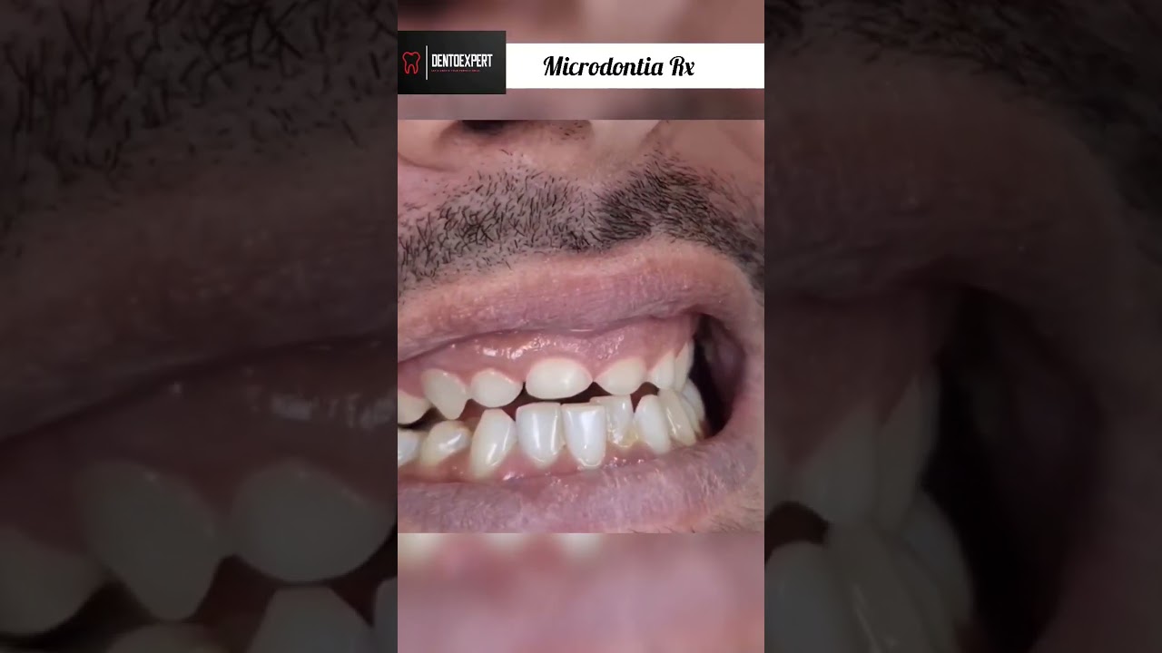 Rx - Microdontia | Small Tooth | Crown Lengthning Procedure 💯 