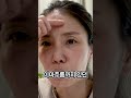 안면거상 전후 40대가 수술한 모습 #안면거상 #안면거상술후기 #shorts