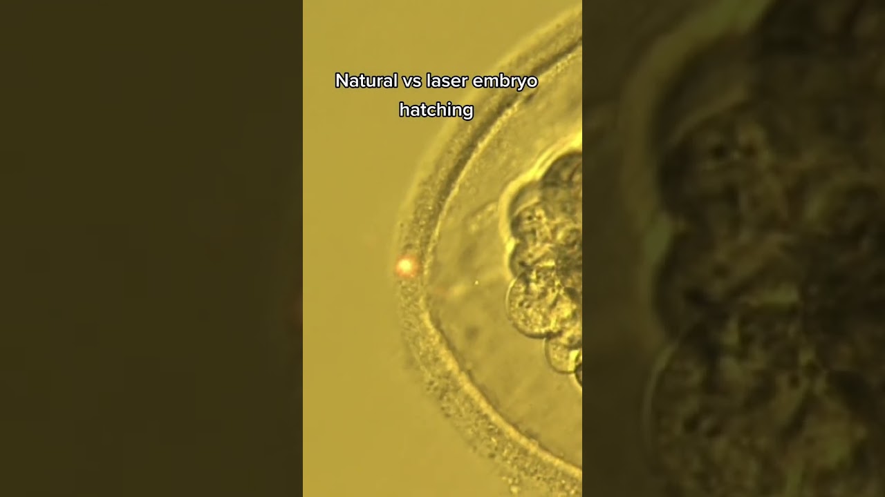 естественный человеческий эмбрион против лазерного хэтчинга
