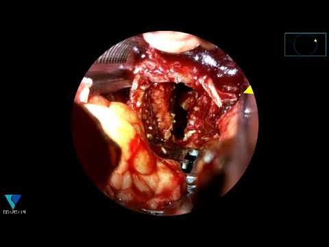 Surgical video of XLIF procedure using Viseon MaxView™ - video from Viseon