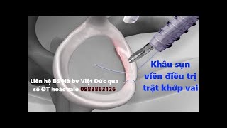 Phẫu Thuật Khâu Sụn Viền Rách Điều Trị Trật Khớp Vai Tái Phát