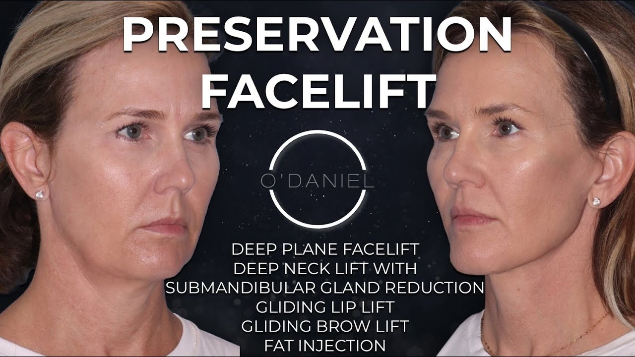 Deep-plane & preservation facelift: full-face harmony