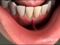 Oral Conditions Frenectomy