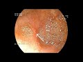 Duodenal vascular lesion (Dieulafoy lesion) bleeding | Endoscopic treatment |