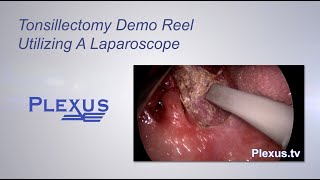 Tonsillectomy Surgical Video