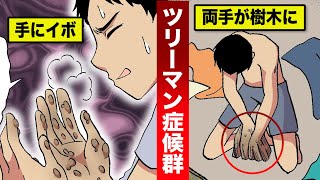 【奇病】イボが大量発生...両手が樹木になる「ツリーマン症候群」を漫画にした