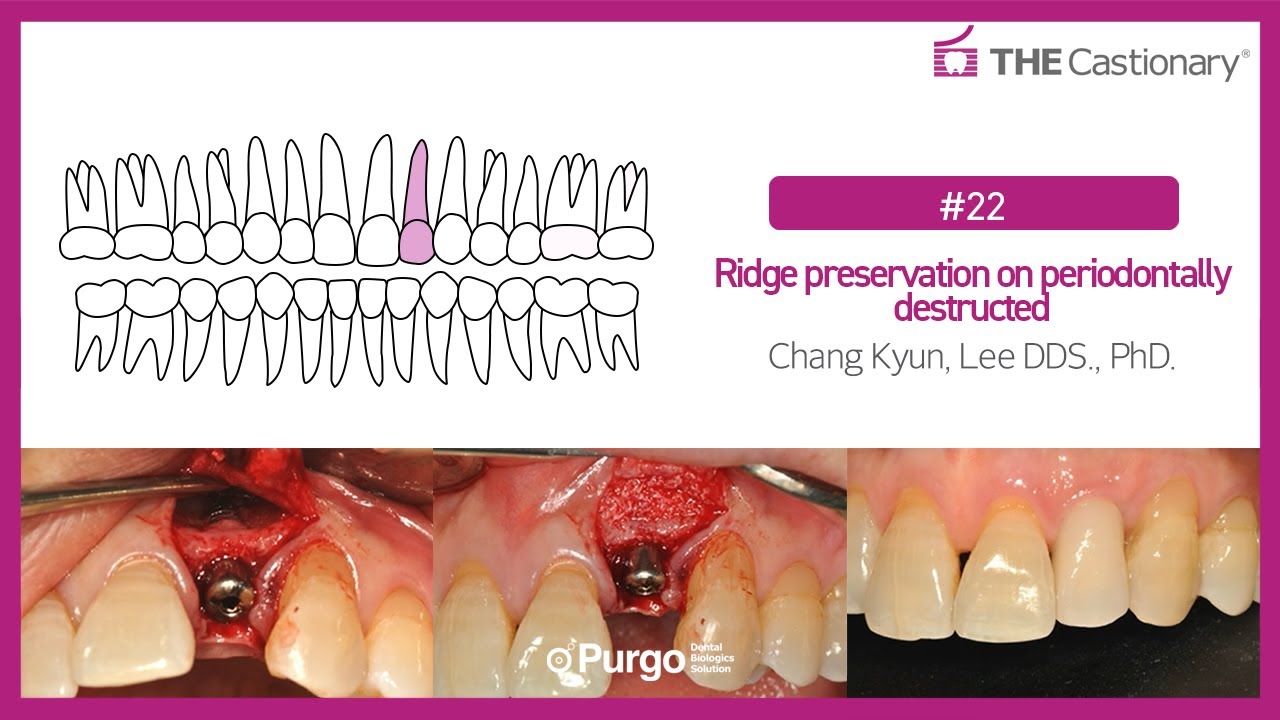 [#12] Ridge preservation on periodontally destructed - YouTube