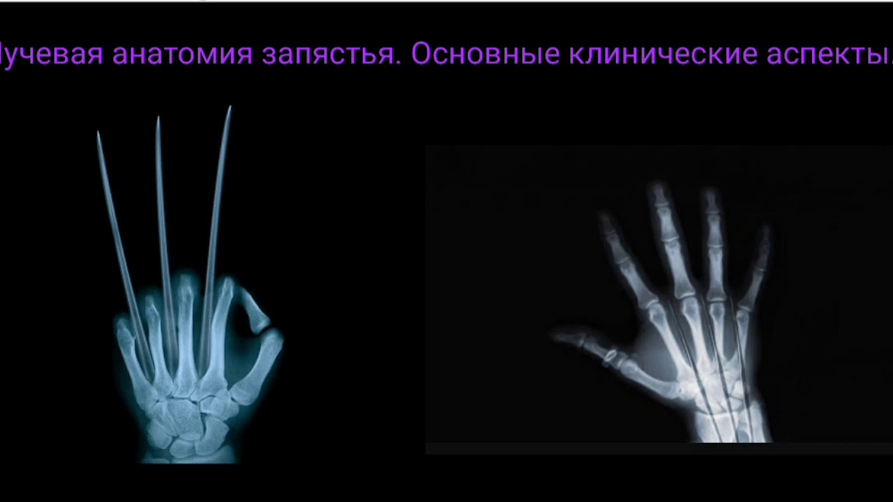 Рентген анатомия запястья. Лучезапястный сустав рентген анатомия. Кости запястья рентген анатомия. Кости лучезапястного сустава анатомия рентген. Суставы запястья рентген анатомия