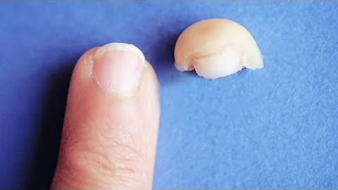 CNN: Woman grows back severed finger tip