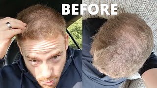 The BEST Haircut For My Thinning Hair Was The Buzz Cut - This is Why