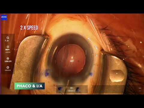 OCT guided triple DMEK