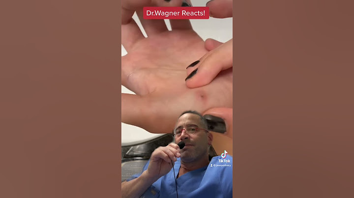 REMOVAL OF INFECTED SPLINTER😫#shorts #splinter