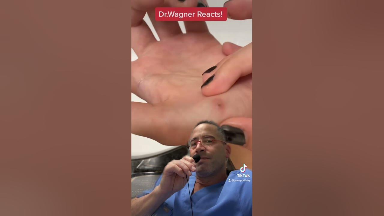 REMOVAL OF INFECTED SPLINTER😫#shorts #splinter