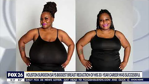 Massive breast reduction performed by Houston surgeon