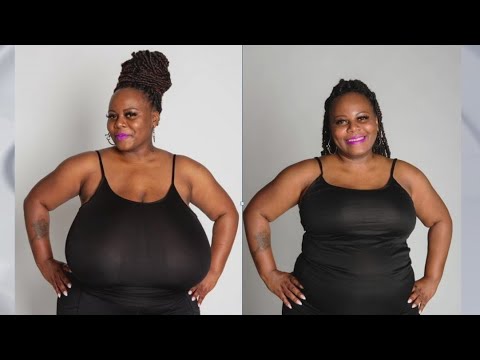 Massive breast reduction