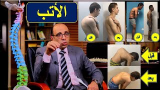 الأتب او تحدب العمود الفقري: ما هو الأتب، انواعة و طرق علاجة للأطفال و الكبار مع صور توضيحية لكل نوع